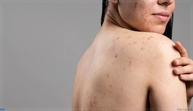 Baixos níveis de ômega 3 ligados à acne