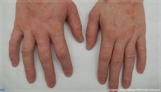 Conexão intestino-pele é fator central em casos de dermatite atópica, mostra revisão de estudos