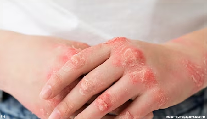 Fiocruz e Bayer firmam acordo para oferecer reforço ao tratamento da doença de Chagas