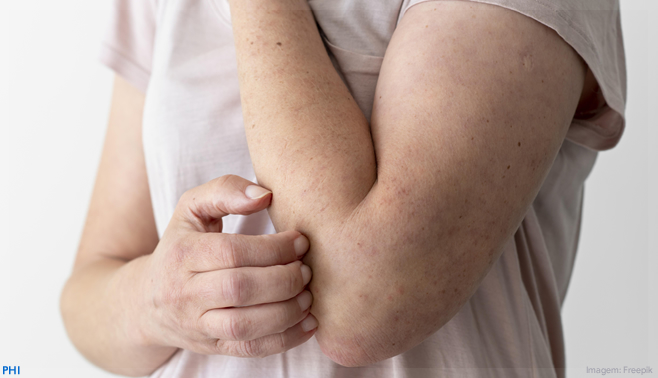 Saúde anuncia R$ 55 milhões para prevenção e tratamento de Hanseníase