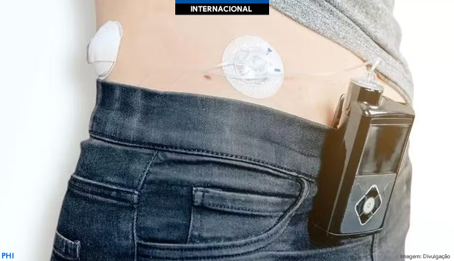 Diabetes: Reino Unido se torna 1º país a oferecer ‘pâncreas artificial’ na rede pública