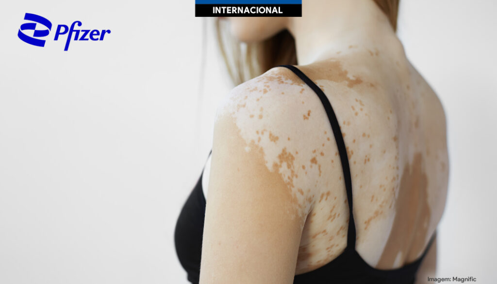 Pfizer avança com Litfulo e reporta resultados positivos em vitiligo